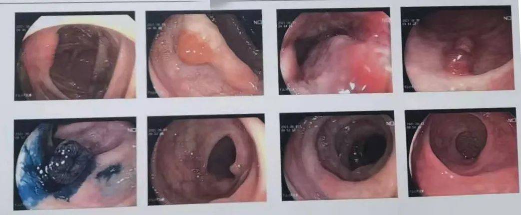 表弟|59岁男子与表弟双双查出肠癌