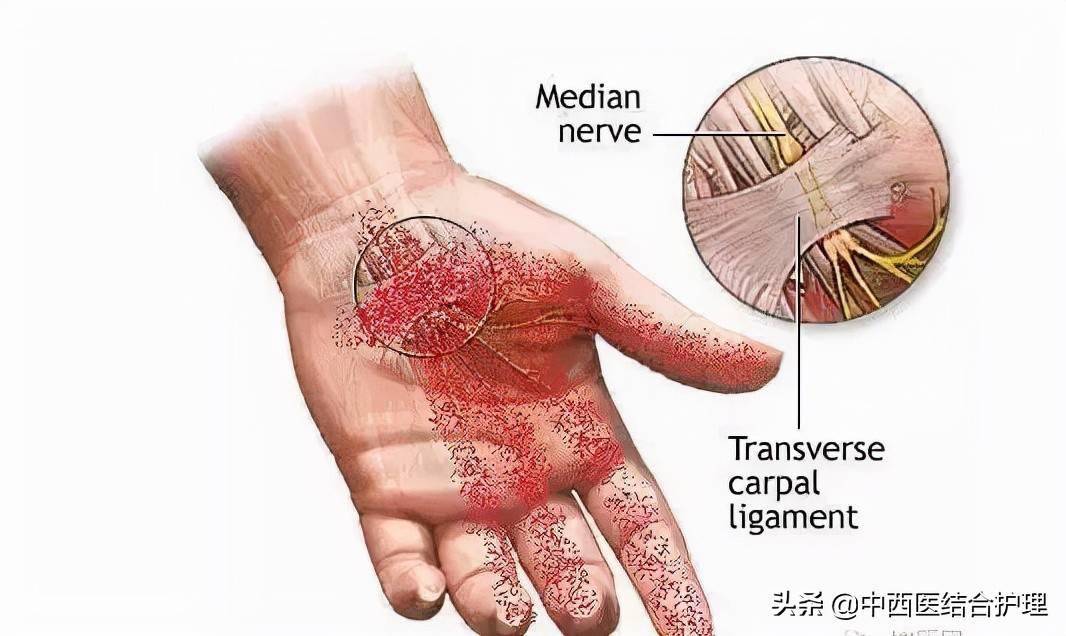 「健康科普」经常手麻的人要注意了,你的身体可能出现了这些问题