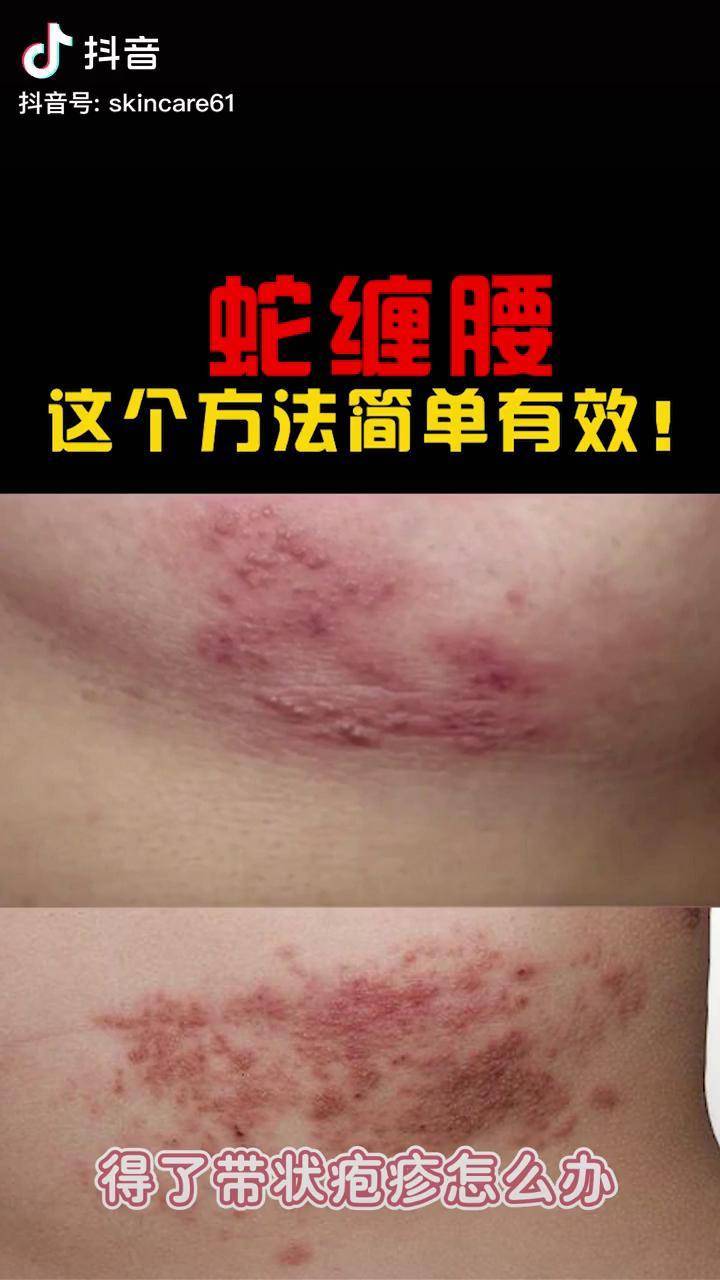 得了蛇缠腰别害怕老刘教你怎么做带状疱疹皮肤医学科普南方健康