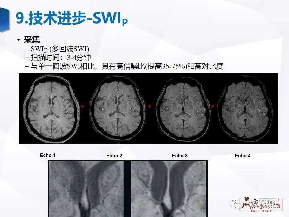 大咖讲堂 | 磁敏感加权成像(swi) 原理及临床应用