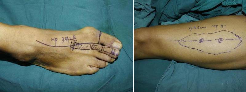 决定在患者的右足取下大脚趾的外皮,指甲,以及第二个足趾的骨头及