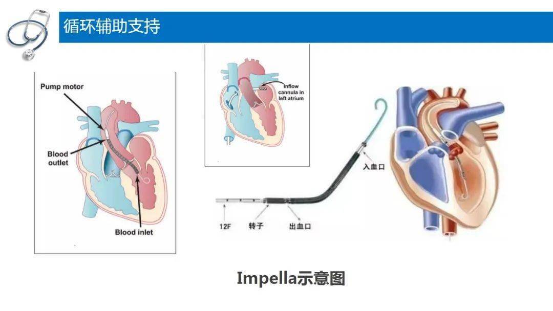 pptiabp主动脉内球囊反搏泵