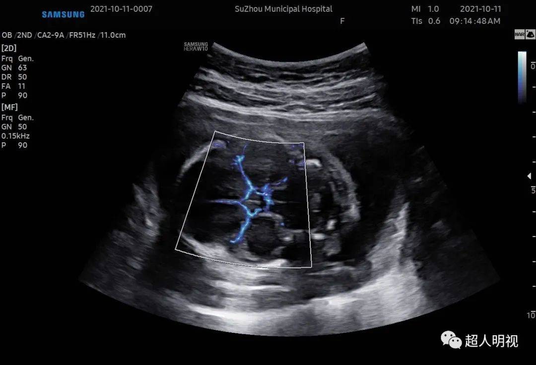 胎儿大脑中动脉sd图片