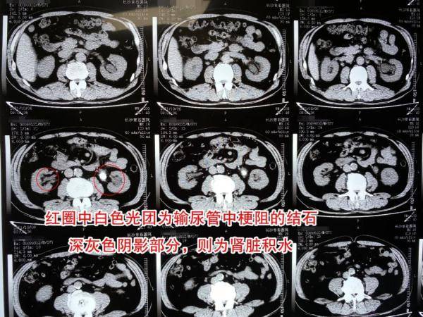 卢卓|男子常年饮浓茶如同“茶罐子”，突发腰胀才知竟患结石