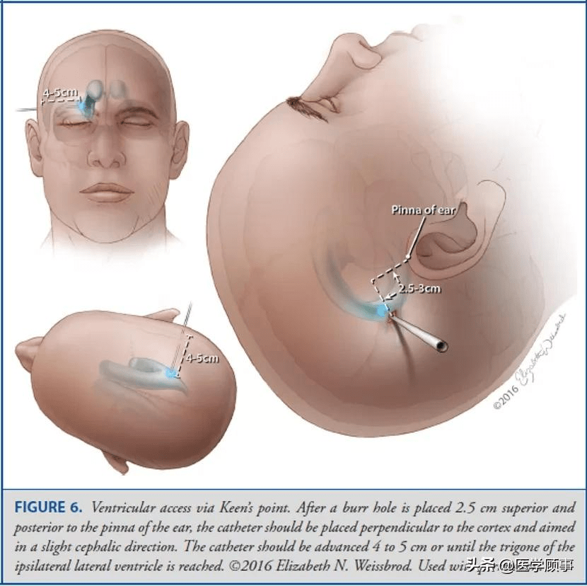 operative neurosurgery:顱骨測量與腦室穿刺