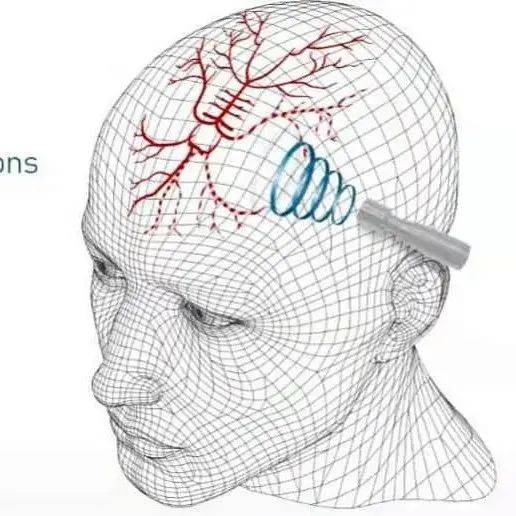 TCCD—给大脑做个彩超_检查