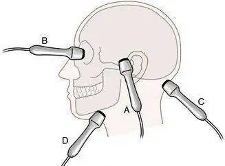 tccd—给大脑做个彩超_检查