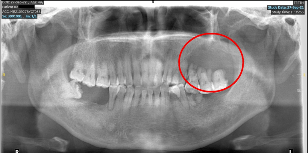牙龈癌图片晚期 x光片图片