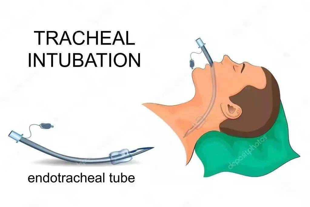 迁医健康插不插管需要理智的选择