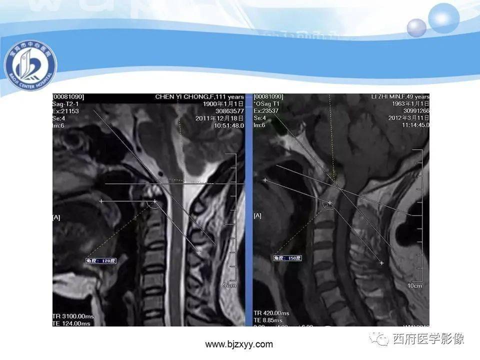 颅底凹陷症的影像诊断与鉴别诊断
