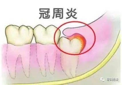 教你拔智齿的最佳方案