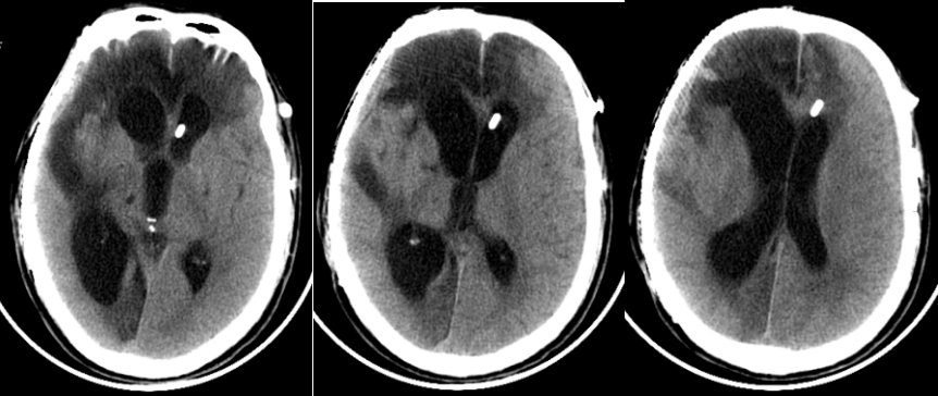 日複查頭顱ct提示:左側硬膜下血腫及積氣積液較前減少,v-p分流管在位