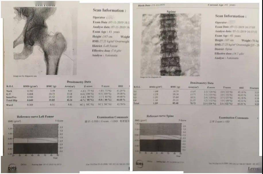 行走|【医文医话】罕见病例 | 低磷骨软化症确诊治疗始末