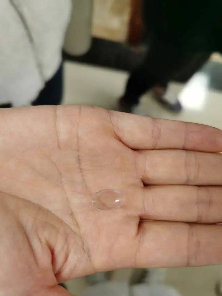 镜盒|35岁女子一夜间从近视400度变远视300度，问题出在老公身上