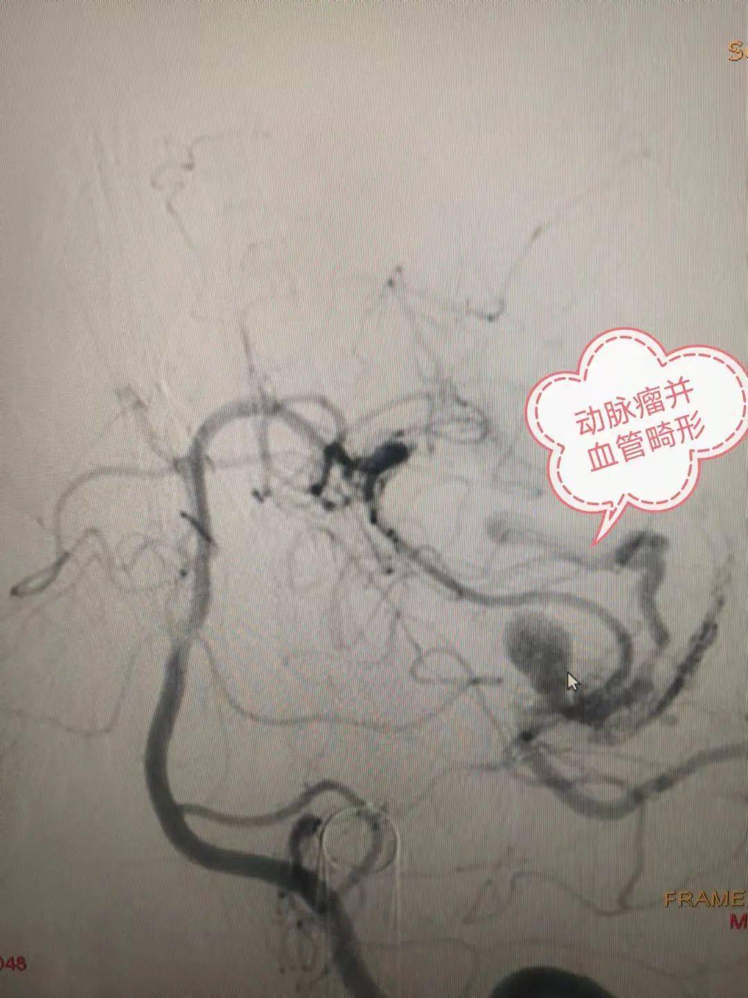 造影結果顯示腦血管畸形合併動脈瘤