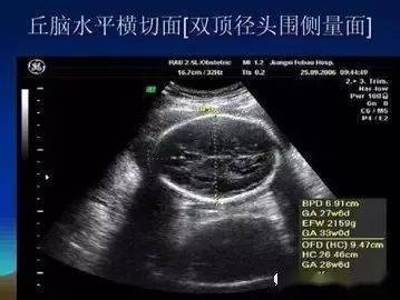 腹围(ac)在超声脐静脉及门窦水平正位轴切面上,胃泡显示,肾脏不可见时