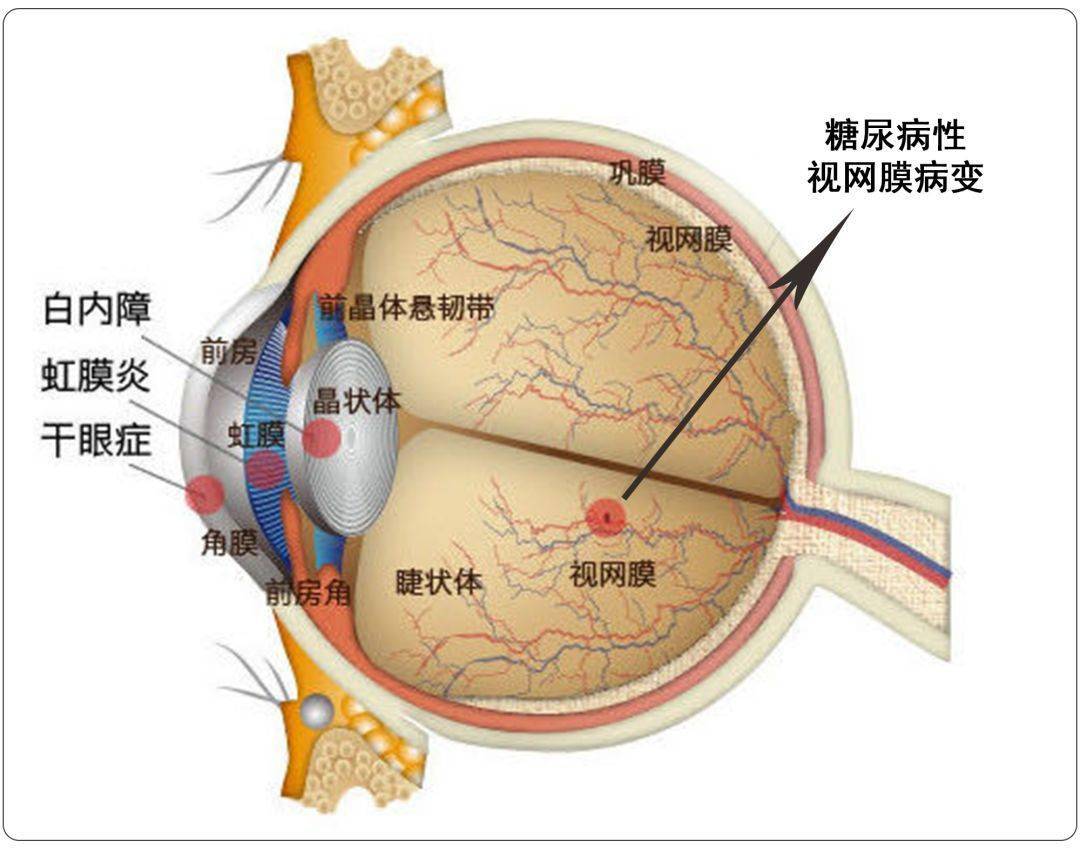 突发性麻痹性斜视 玻璃体,视网膜 糖尿病视网膜病变 03 在眼睛中