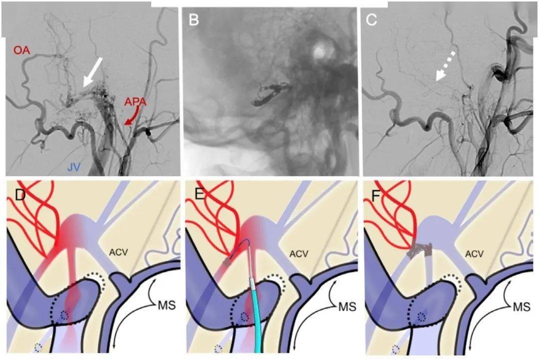 jnis中文版王晓健教授导读边缘窦区硬脑膜动静脉瘘的介入治疗的策略