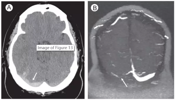 进行|脑出血CT的9大“陷阱”，稍不留神就会误诊