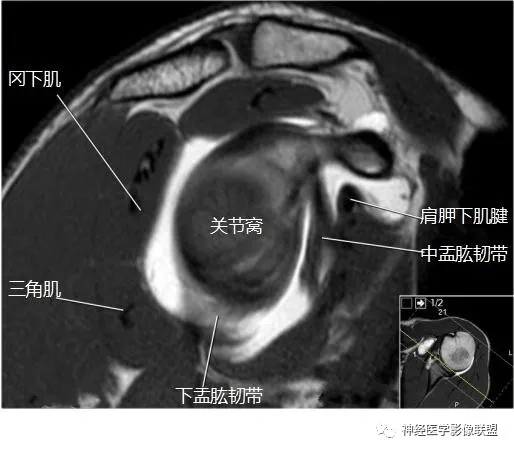 肱骨ct断层解剖图片