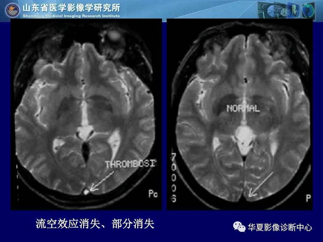 诊断|缺血性脑血管病的影像诊断