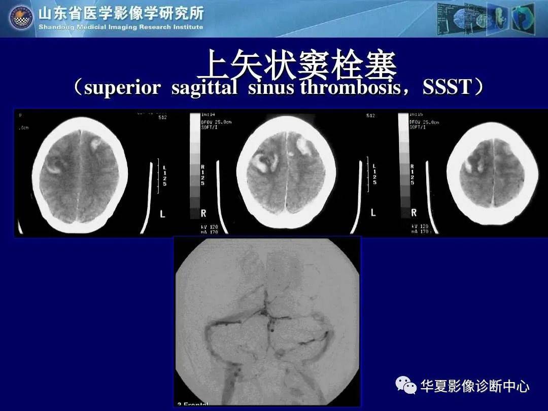 诊断|缺血性脑血管病的影像诊断