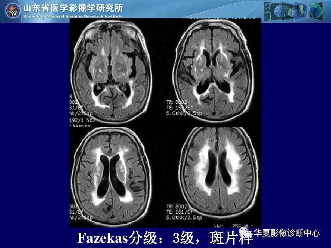 诊断|缺血性脑血管病的影像诊断