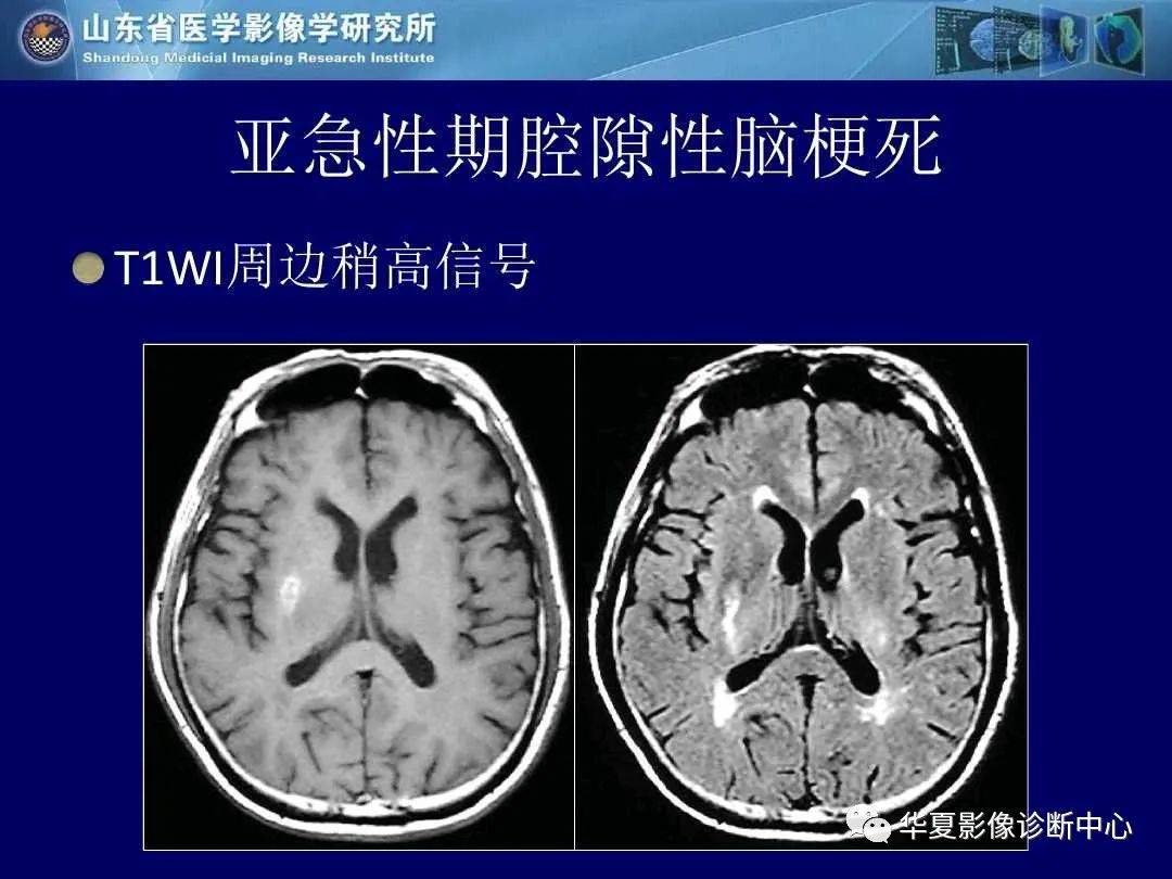 诊断|缺血性脑血管病的影像诊断