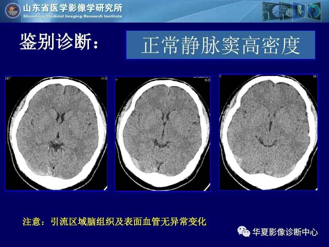 诊断|缺血性脑血管病的影像诊断