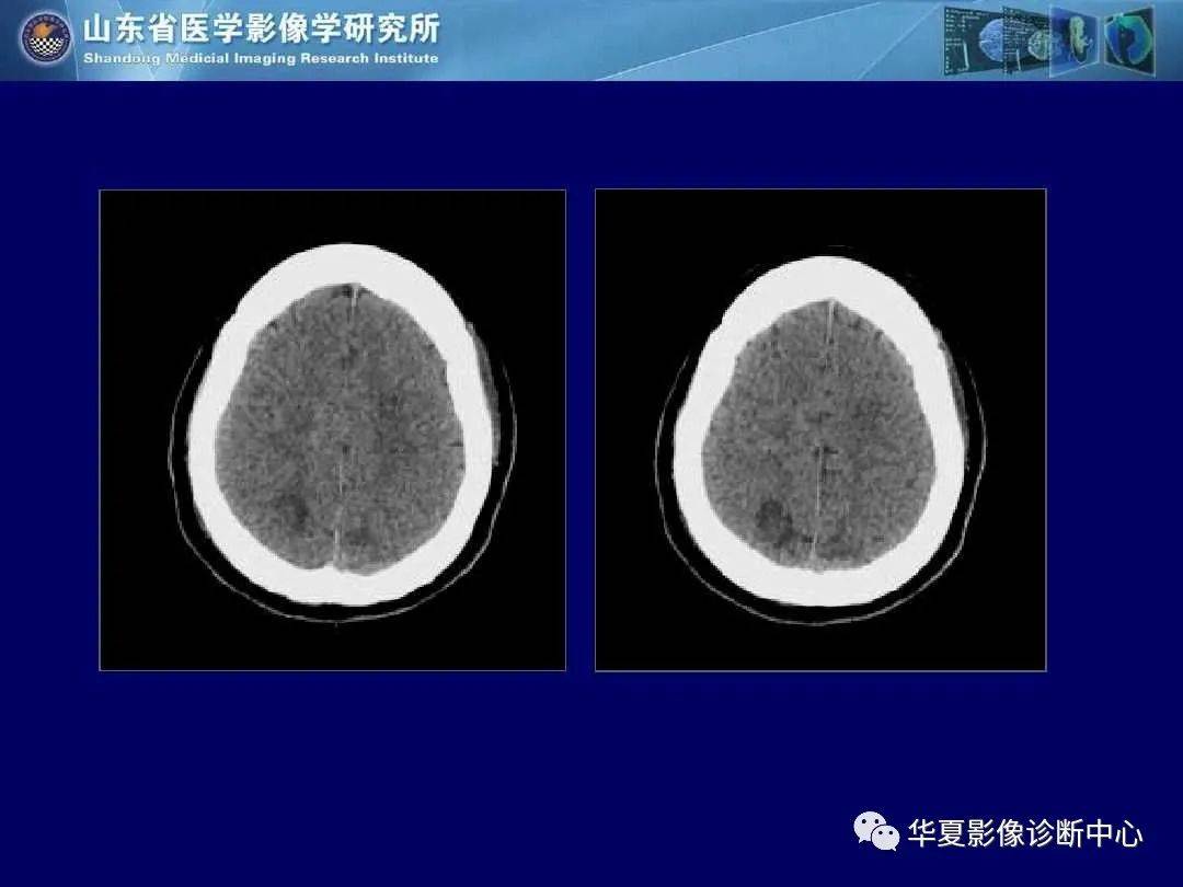 诊断|缺血性脑血管病的影像诊断