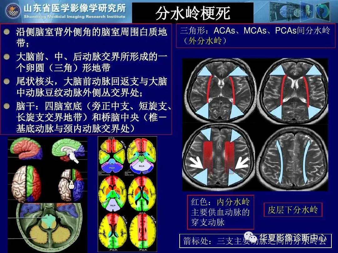 诊断|缺血性脑血管病的影像诊断