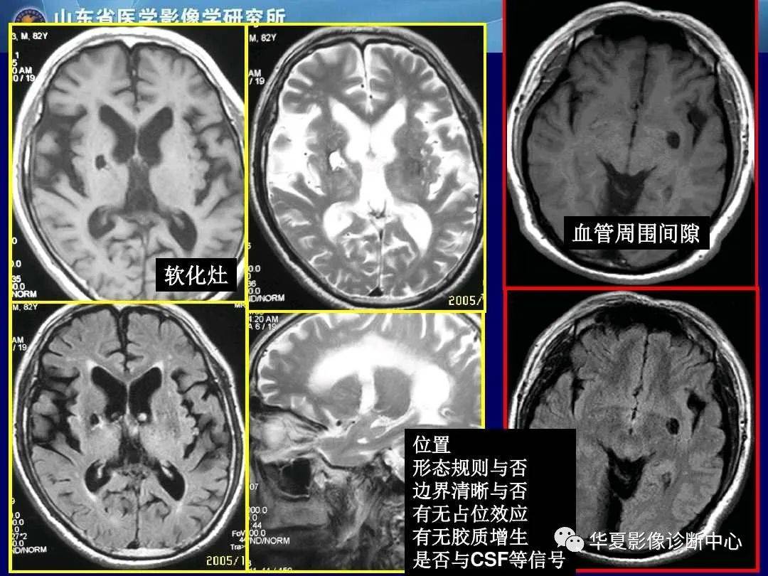 诊断|缺血性脑血管病的影像诊断