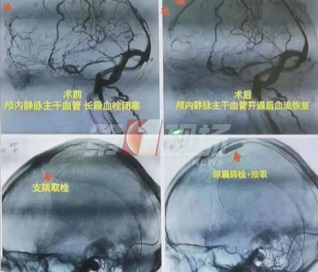 男子|奶茶“续命”？男子进ICU，颅内长出这东西