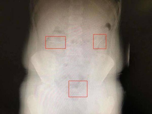 小肠|为向同学“证明”自己是魔术师，10岁男孩连吞四枚定位针