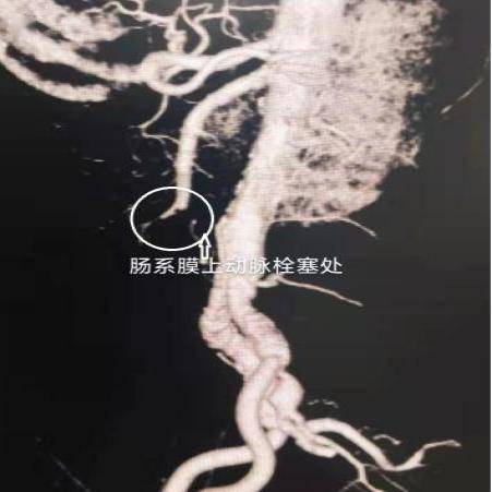 救治|西安交大一附院专家团队成功救治高龄心衰患者突发急腹症