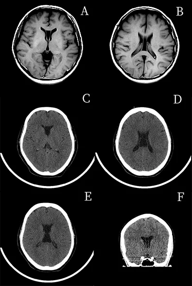 影像表现:a,b 为同一患者,头颅 mri 平扫横断位 t1wi 可见双侧脑室