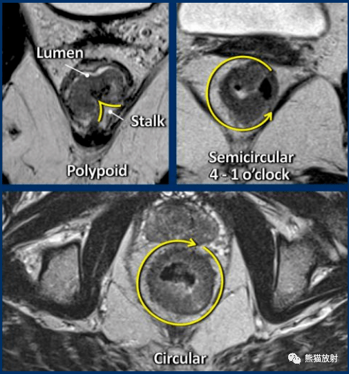 mri