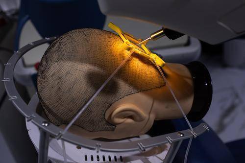 植发手术辅助机器人在进行现场演示.新华社发