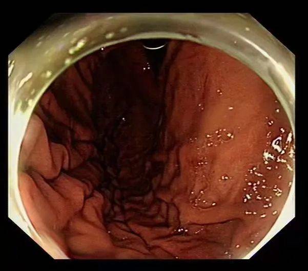 男子|男子胃里取出衣架、塑料管！在肚里待了3个月