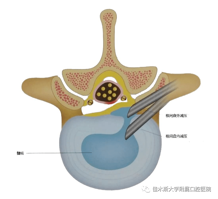 椎间孔镜动画演示图片