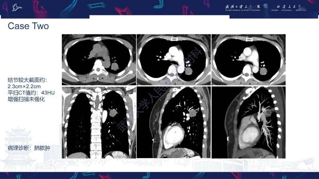活动性肺结核不典型ct表现