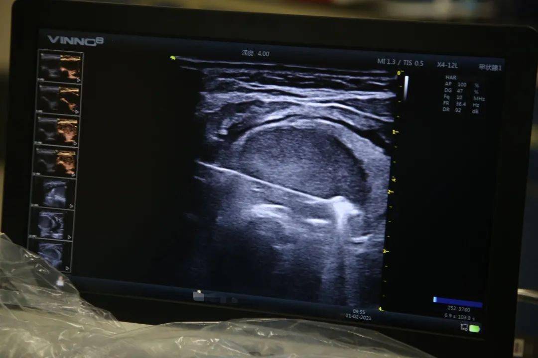 消融术|走进手术室 | 这个体检出来的甲状腺“炸弹” 不用开刀也能“拆除”