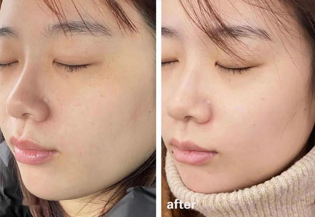 第一个超值项目依旧是"初学者"必备全能医美项目光子嫩肤,也是我们上