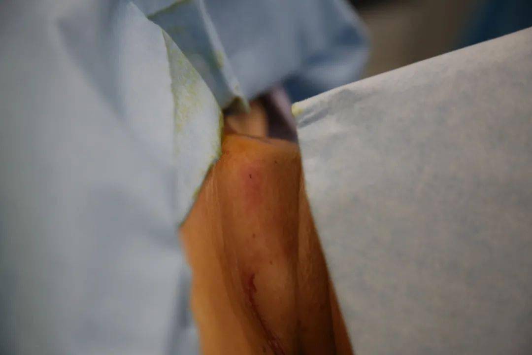 消融术|走进手术室 | 这个体检出来的甲状腺“炸弹” 不用开刀也能“拆除”