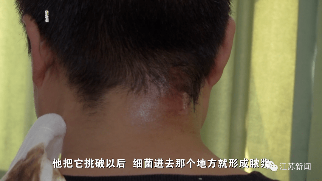 結果|男子隨手擠了顆痘痘，結果長出拳頭大膿包