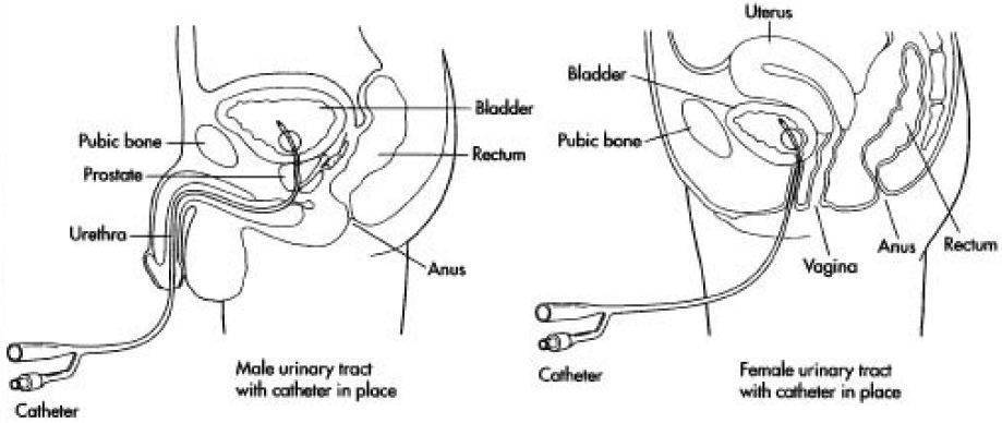 导尿管结构组成图片