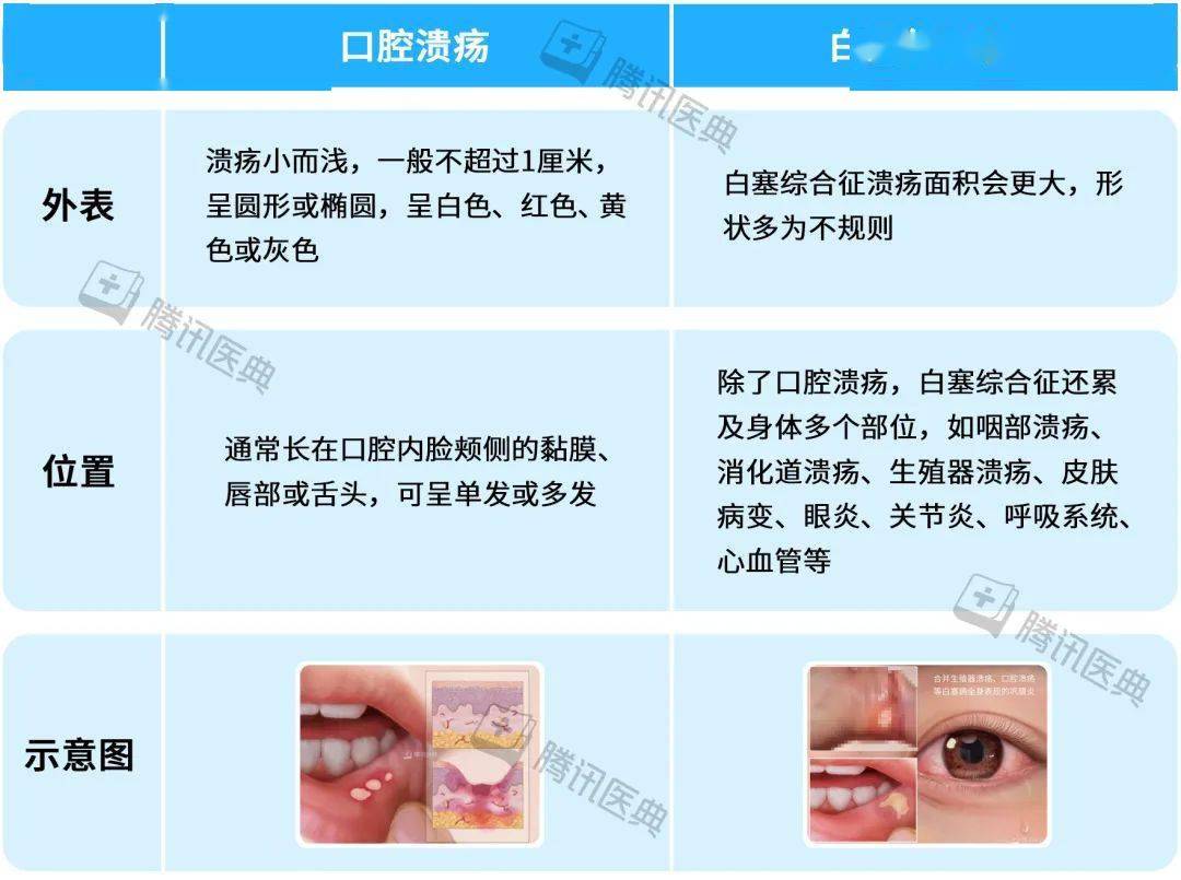 腭扁桃体溃疡图片图片