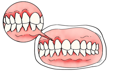 牙龈红线示意图图片