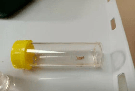 检查|【新闻快递】呼吸重症监护室成功开展两例危重症患者“床旁超声引导下经皮肺穿刺组织活检术”