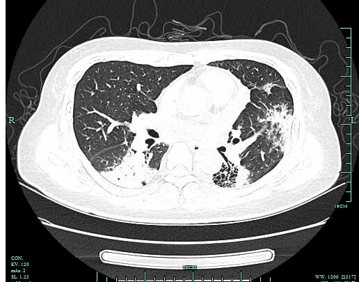 检查|【新闻快递】呼吸重症监护室成功开展两例危重症患者“床旁超声引导下经皮肺穿刺组织活检术”